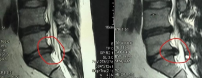 分享“修補腰間盤”的方子!改善腰間盤突出,腰疼、腿疼、屁股疼 分享“修補腰間盤”的方子!改善腰間盤突出,腰疼、腿疼、屁股疼