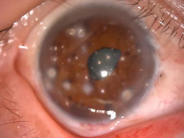 外傷白內障合併角膜瘢痕，20年後重見光明