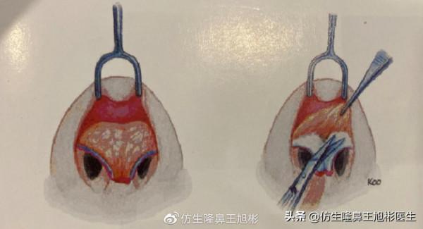 鼻頭縮小可以只“減脂”，不取自體軟骨做支架嗎？