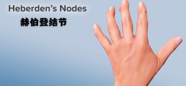 五十多歲的女性們，您有晨起手指僵硬、疼痛，甚至變形的現象嗎？