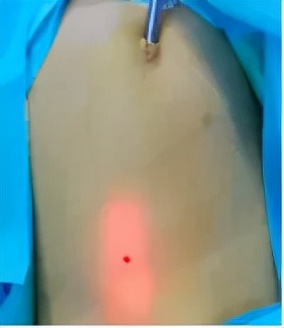 揪心！2個月大早產兒列車上突發疝氣，兒童腹股溝疝氣該如何預防