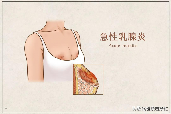 急性乳腺炎的中西醫辯證及調理方法
