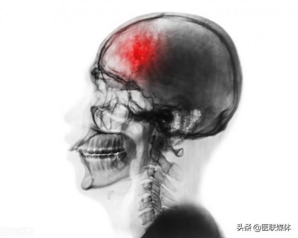 做好這5點，預防腦卒中不是事！您能做到幾個？