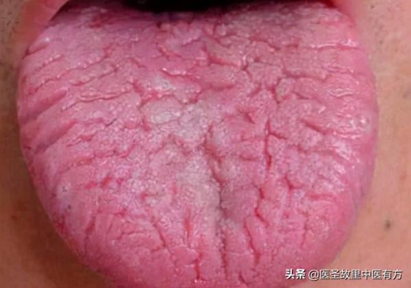 舌有裂紋，是身體有病的表現！這些中藥驗方，專治舌裂舌痛舌幹