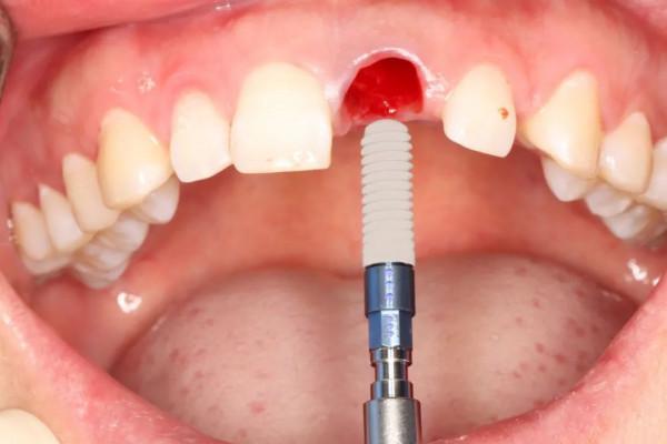 同仁醫線丨精準種植，美學修復，再也不用愁眉苦臉了