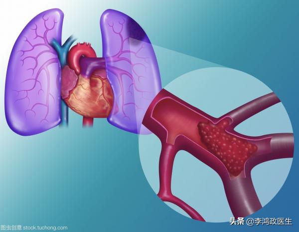 男子腹痛腹瀉，迅速休克病因未明，直至看到患者胸口上的紅點