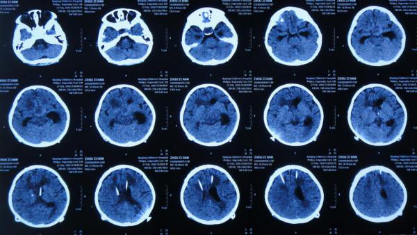 顱內生殖細胞瘤切除術後腦積水仍反覆,意識模糊,左側肢體偏癱 顱內生殖細胞瘤切除術後腦積水仍反覆,意識模糊,左側肢體偏癱