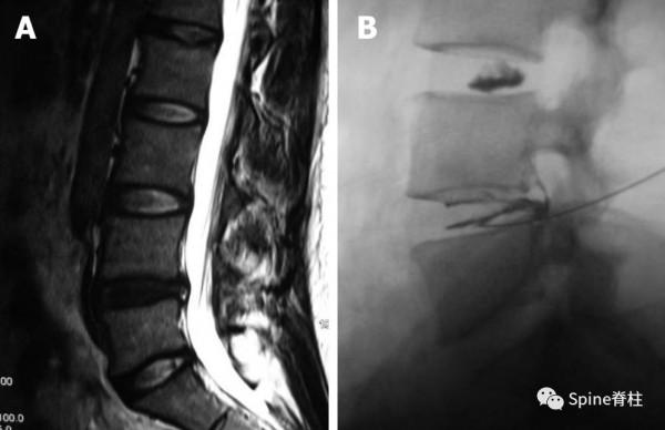 椎間盤源性腰痛 (discogenic low back pain) 椎間盤源性腰痛 (discogenic low back pain)