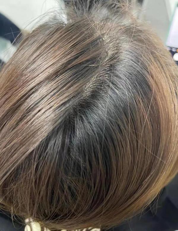 脫髮掉頭髮嚴重,先從調理腎氣開始 脫髮掉頭髮嚴重,先從調理腎氣開始