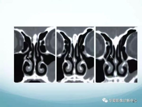 頭頸五官CT斷層解剖圖及常見病影像診斷