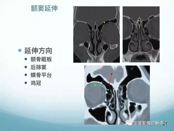 頭頸五官CT斷層解剖圖及常見病影像診斷