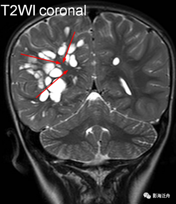 VR腔隙、腔梗灶、微出血、脫髓鞘，傻傻分不清？快看這裡