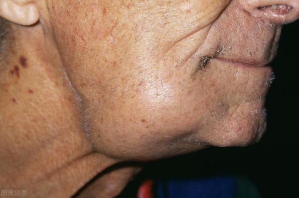 得淋巴癌的原因有哪些? 得淋巴癌的原因有哪些?