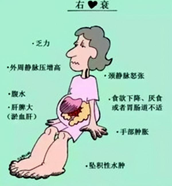 心臟功能要是衰竭了,病人會有哪些表現? 心臟功能要是衰竭了,病人會有哪些表現?