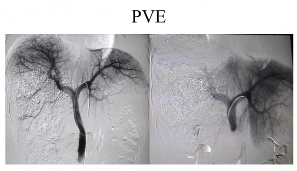肝癌5年等來了醫學的進步，他說：人在，日子就會越來越好