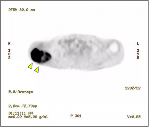 案例：透析的晚期腎癌患者能否應用免疫聯合靶向治療？