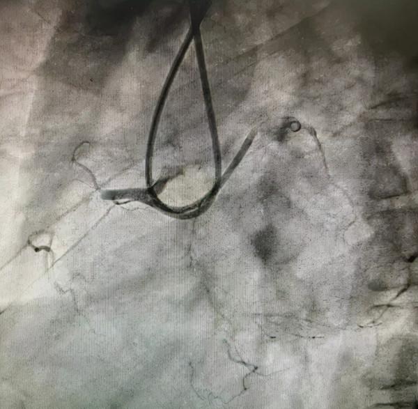 再克技術堡壘，巧破閉塞病變