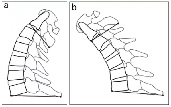 頸椎矢狀面活動度影像學改良測量方法的初步應用