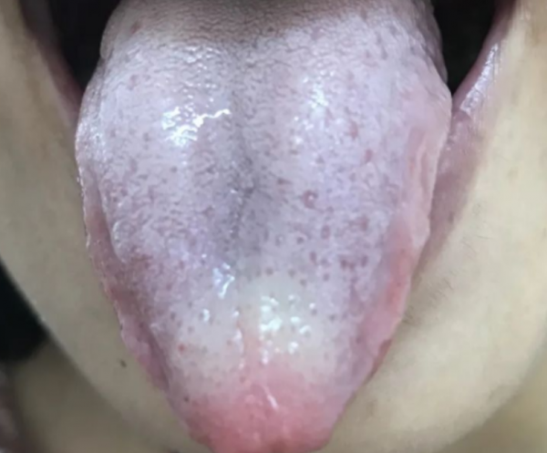 痰多難除?中醫:善治痰者,不治痰而治氣,用治氣法掃除全身之痰 痰多難除?中醫:善治痰者,不治痰而治氣,用治氣法掃除全身之痰