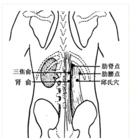 泌尿繫結石併發症，還可以用中醫治！
