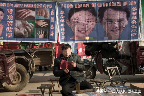 路邊很火的藥水點痣,一分鐘點好七天消除,面板科醫生有話想說 路邊很火的藥水點痣,一分鐘點好七天消除,面板科醫生有話想說