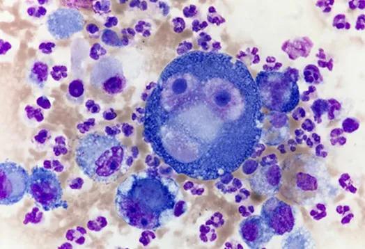 腦脊液細胞學找到“孫大聖”