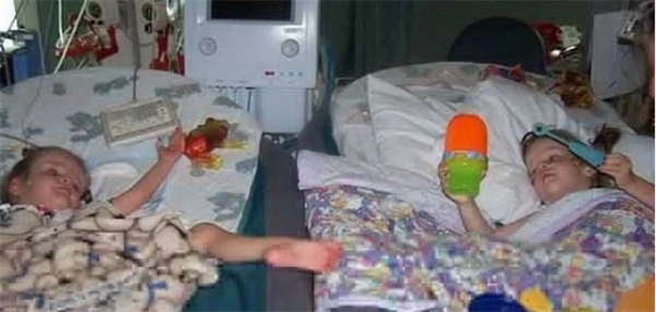 雙胞胎女嬰腹部相連醫生都說活不了，4歲做分離手術如今已滿20歲