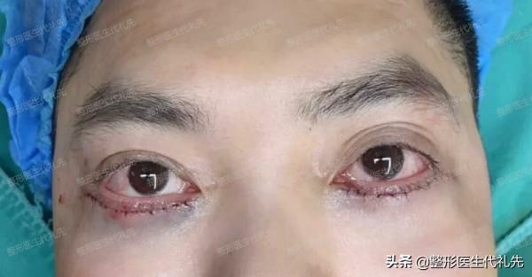 最值得35~70歲男士做的眼周年輕化術式－外路祛眼袋手術