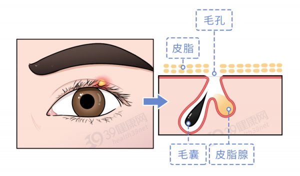 長了麥粒腫，怎麼治療好得快？一定要開刀嗎？這幾件事要記住