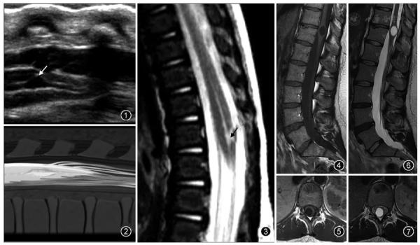 “第五腦室”是透明隔腔嗎? “第五腦室”是透明隔腔嗎?