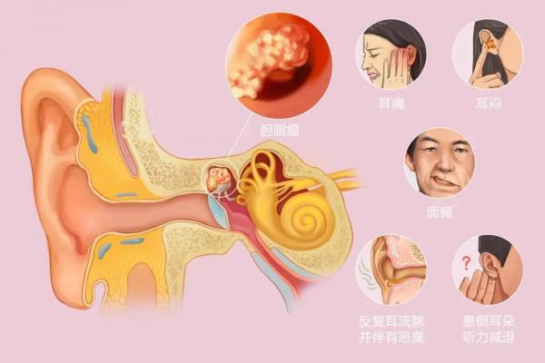 醫生眼中善良的6種“瘤”,查出來別怕,不會惡化,有的根本不是腫瘤 醫生眼中善良的6種“瘤”,查出來別怕,不會惡化,有的根本不是腫瘤