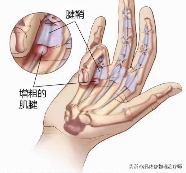 正處在更年期的您，是否遭受著頸肩背痛的折磨？告知您如何應對