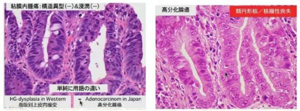 早期胃癌病理診斷：WHO VS.日本標準一文解析