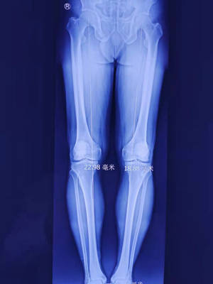 「運動醫學」關節透支行走難，關節鏡下截骨保膝