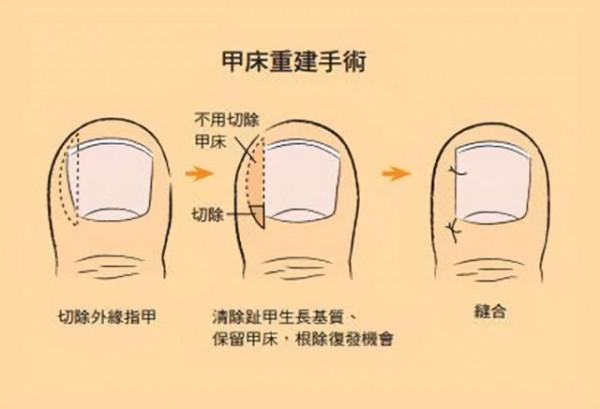 化療副作用之癌症治療期間常見的指甲問題