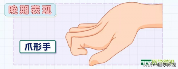 1萬人中有4人，小腿會悄悄變“瘦”，但希望不是你