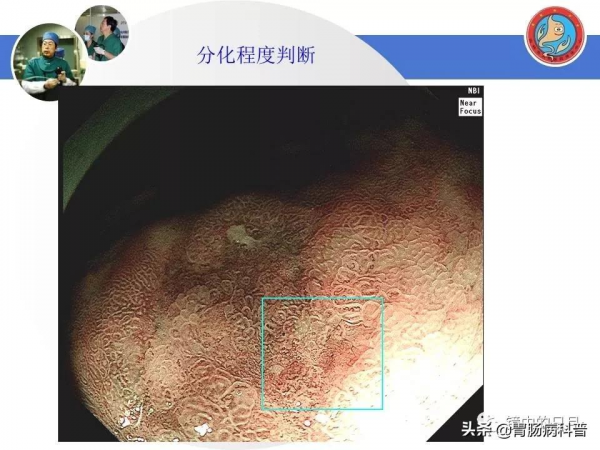 早期胃癌——內鏡診治流程