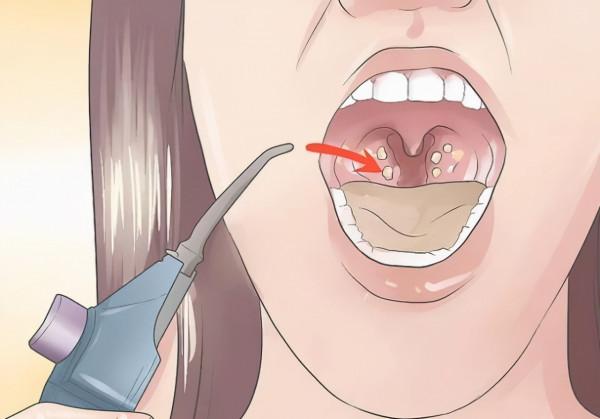 扁桃體結石｜不規則的小顆粒，非常臭，還忍不住想聞？本文說清楚