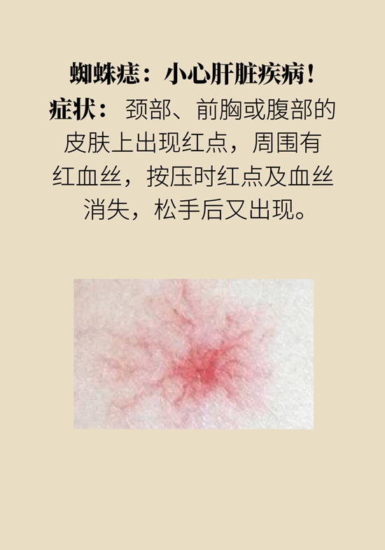 身上出現紅斑、紅點別不當回事，警惕癌變