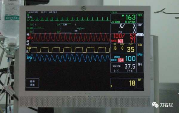惡性高熱第1例:2007年西京醫院術中“惡性高熱”一例 惡性高熱第1例:2007年西京醫院術中“惡性高熱”一例