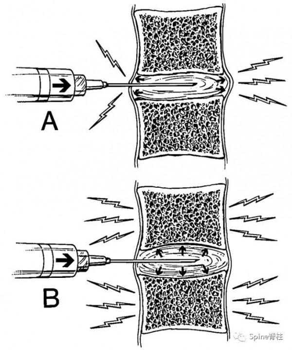 椎間盤源性腰痛 (discogenic low back pain) 椎間盤源性腰痛 (discogenic low back pain)