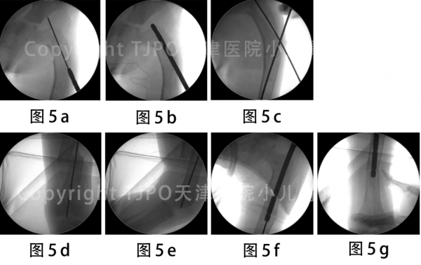 病例分享｜纖維異樣增殖症股骨近端牧羊拐畸形的矯正