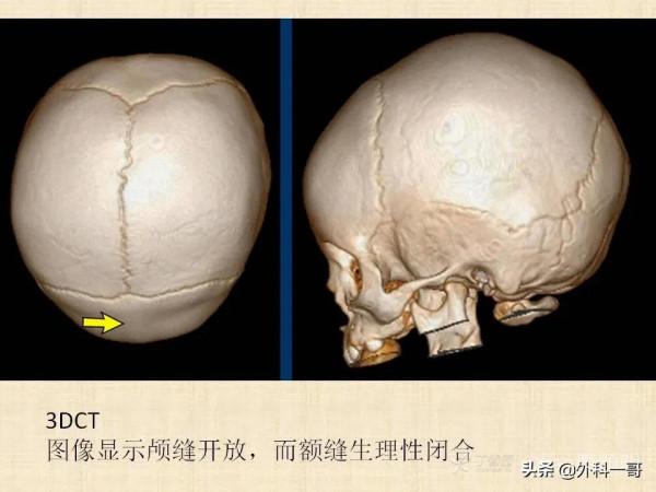 小兒顱縫早閉的診斷治療
