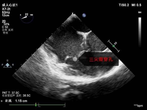30歲小夥多次發燒胸悶,竟是心臟出了問題!醫生:別不當回事 30歲小夥多次發燒胸悶,竟是心臟出了問題!醫生:別不當回事