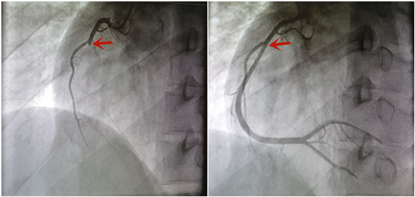 父子兩“煙槍”先後犯心梗，專家：愛護心血管，請務必戒菸