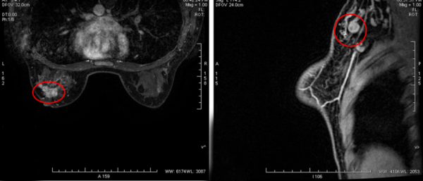 愈見未萊 | 恩美曲妥珠單抗助力HER2+早期乳腺癌患者的生存率再上新臺階