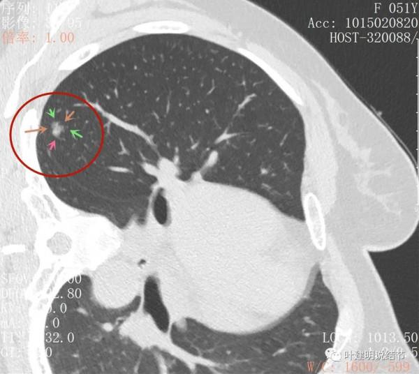 指南說小於5毫米的肺結節不需要隨訪，打臉來了