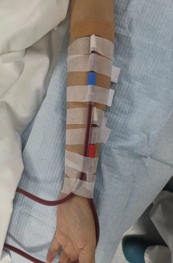 腎臟完全“罷工”,廣西一女子靠透析活著!醫生在她手上畫滿了“生命線” 腎臟完全“罷工”,廣西一女子靠透析活著!醫生在她手上畫滿了“生命線”
