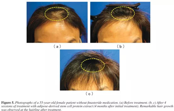 重大發現！免疫細胞與“禿頂”有很大關聯，焦點還是幹細胞