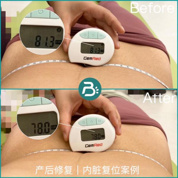 產後肚子如何恢復如初?專家:產後需要從裡到外逐層修復腹部 產後肚子如何恢復如初?專家:產後需要從裡到外逐層修復腹部